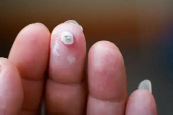 Image of white wart before cryopen treatment Market Harborough