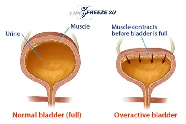 diagram of overactive bladder treatment Market Harborough