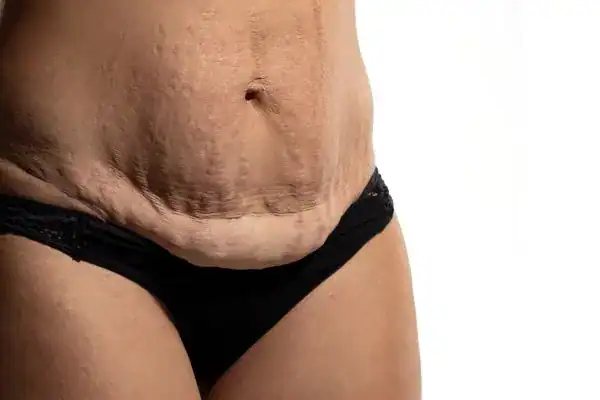 loose skin after weight loss injections Market Harborough