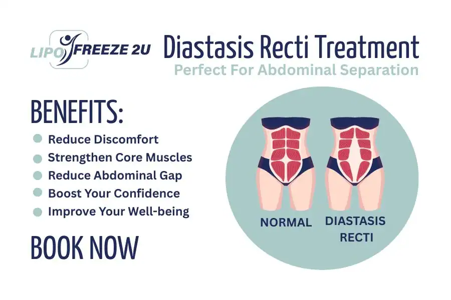 Benefits of body toning treatment Market Harborough for Diastasis recti