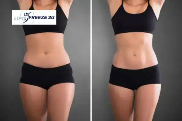 How Can LIPO FREEZE 2U Support Your Post-Pregnancy Body Recovery Market Harborough?
