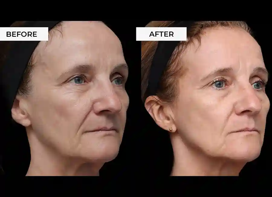 How Many RF Microneedling Sessions Will You Need to See a Difference Market Harborough?