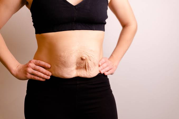 Is Surgery Really the Only Way to Repair Diastasis Recti Market Harborough?