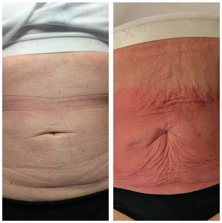 How Does RF Microneedling Improve Crepey, Thin and Uneven Skin Texture Market Harborough?