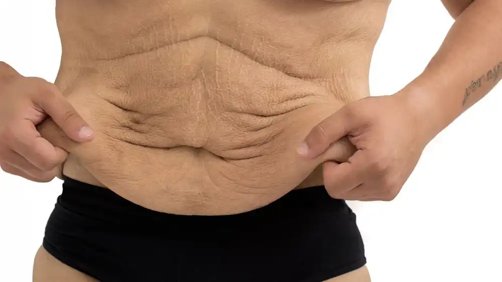 Why Does Weight Loss Medication Leave Some People With Loose or Sagging Skin Market Harborough?